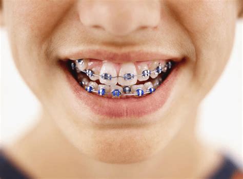 braces inside teeth cost